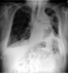 Multi-Exit Class Activation Map Guided Feature Masking for Unsupervised Out-of-Distribution Detection in Medical Imaging