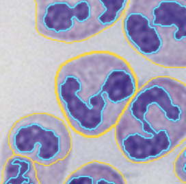 CD177 Deficiency Defines a Stable Subtype of Human Neutrophil Granulocytes with Tumor Promoting Activity